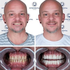 before-after photo zirconia-crown-installation