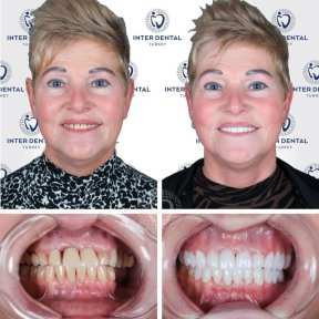 before-after photo zirconia-crown-installation