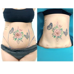 Before and after Vaser liposuction results at Cosmacare clinic, abdomen contour improvement