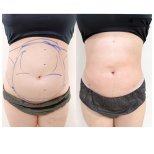 Before and after Vaser liposuction results at Cosmacare clinic, visible abdomen contouring