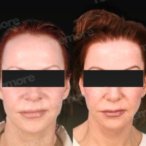 before-after photo forehead-contouring