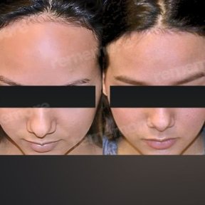 before-after photo forehead-contouring