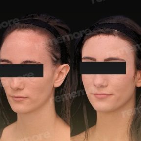 before-after photo forehead-contouring