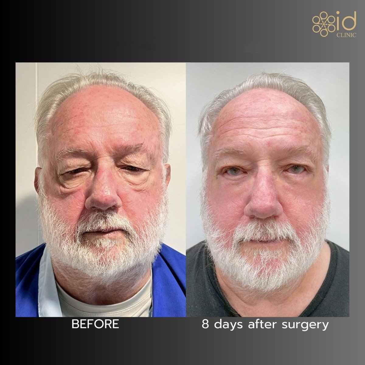 Resultados antes y después de cirugía de párpado caído en ID Clinic Bangkok, mejora ocular