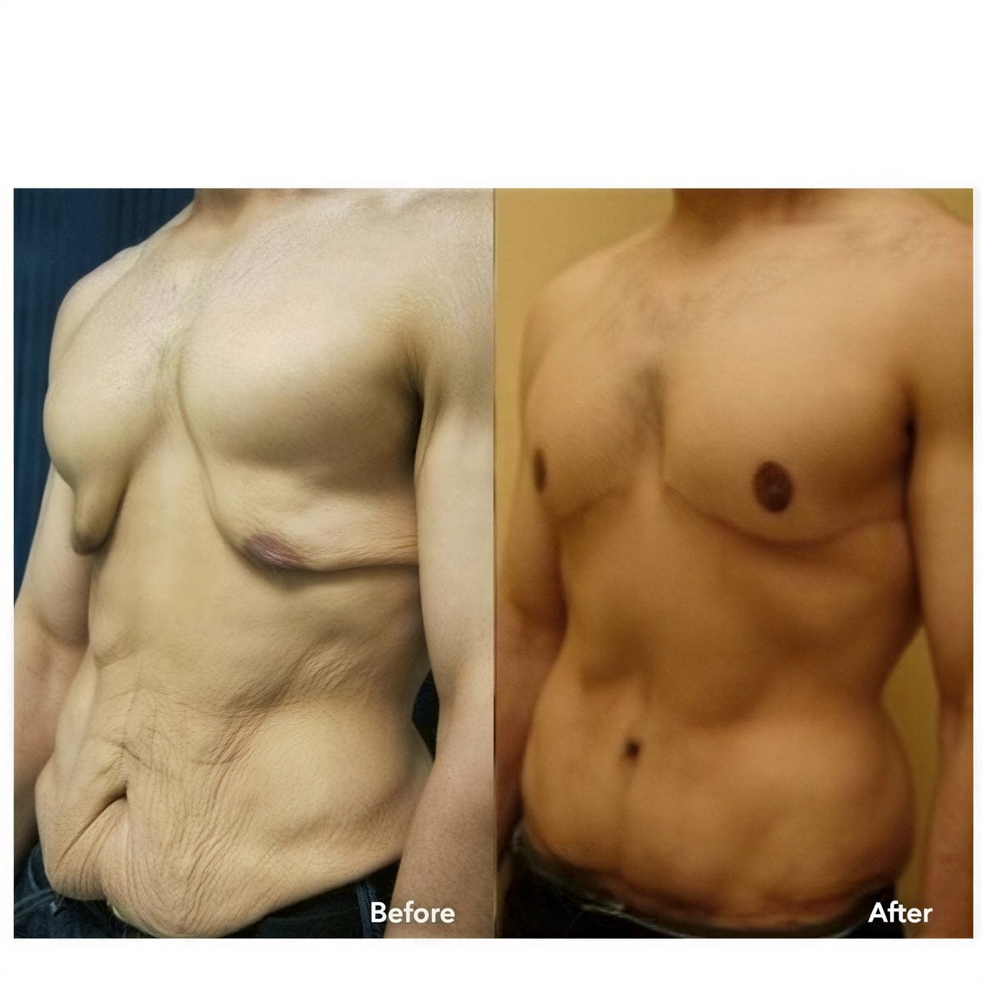Resultados de abdominoplastia y liposucción en ID Clinic Bangkok, abdomen mejorado