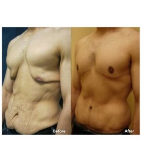 before-after photo abdominoplastika-i-liposakcia