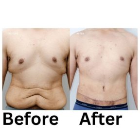 before-after photo abdominoplastika-i-liposakcia