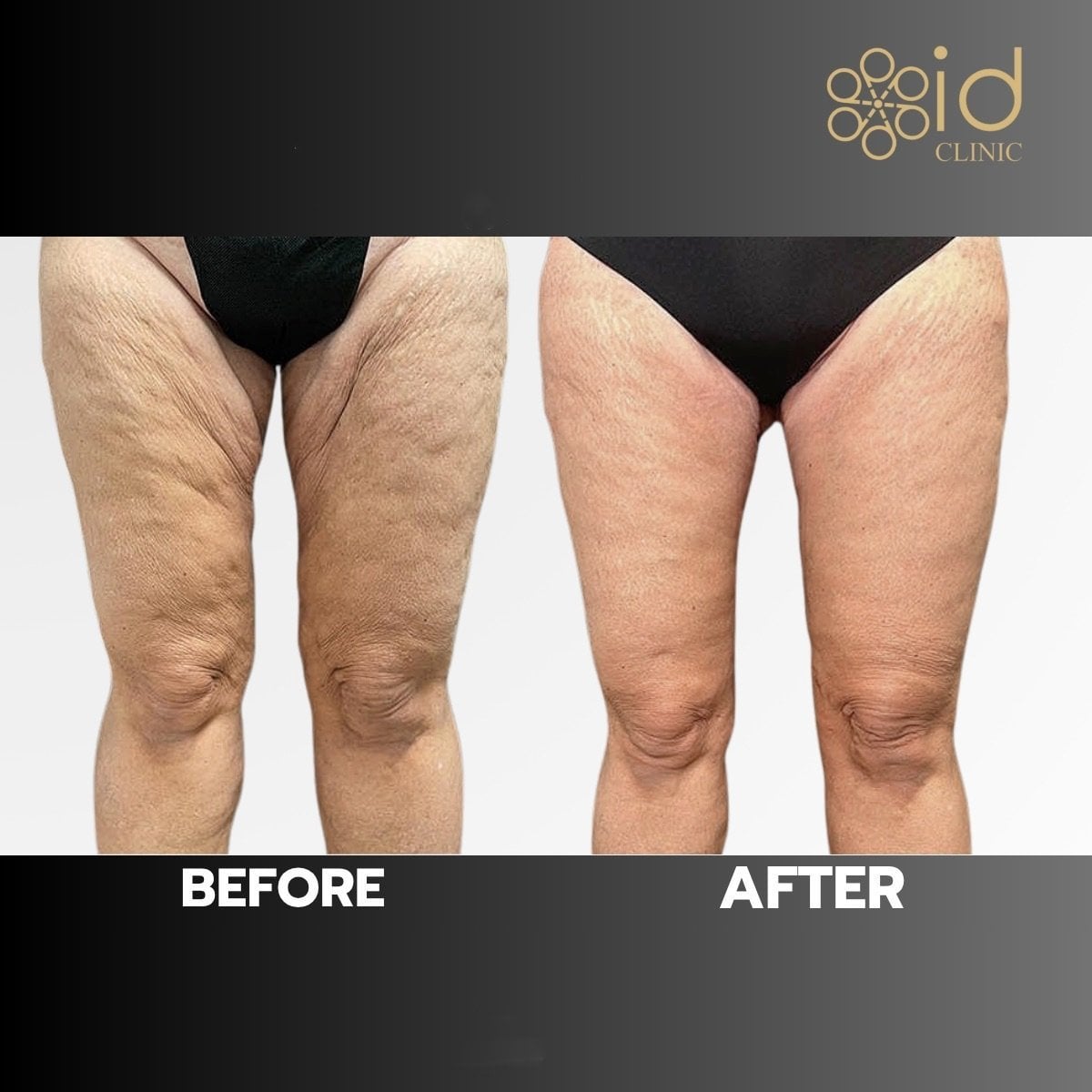 نتائج شد الفخذين قبل وبعد في ID Clinic Bangkok، تحسين شكل الساق وشد الجلد