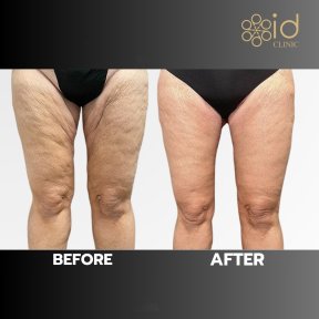 before-after photo podtazka-beder