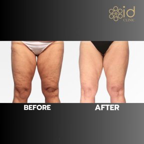 before-after photo podtazka-beder