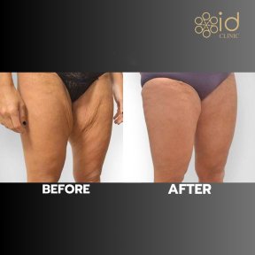 before-after photo podtazka-beder