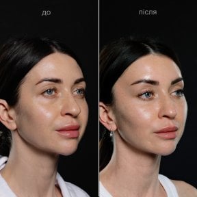 before-after photo glubokaya-podtyazhka-lica-deep-plane-facelift