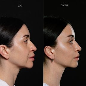 before-after photo glubokaya-podtyazhka-lica-deep-plane-facelift