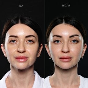 before-after photo glubokaya-podtyazhka-lica-deep-plane-facelift