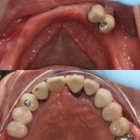before-after photo dental-implant