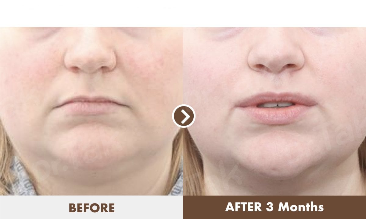 نتائج قبل وبعد رفع الشفاه في عيادة Dr. Tak Plastic Surgery، تحسن شكل الشفاه بعد 3 أشهر