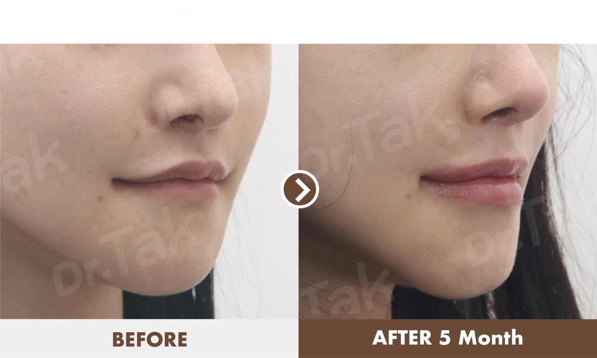 نتائج رفع الشفاه قبل وبعد في Dr. Tak Plastic Surgery، تحسين شكل الشفاه بعد 5 أشهر