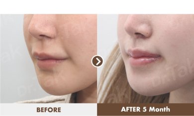 before-after photo lip-lift