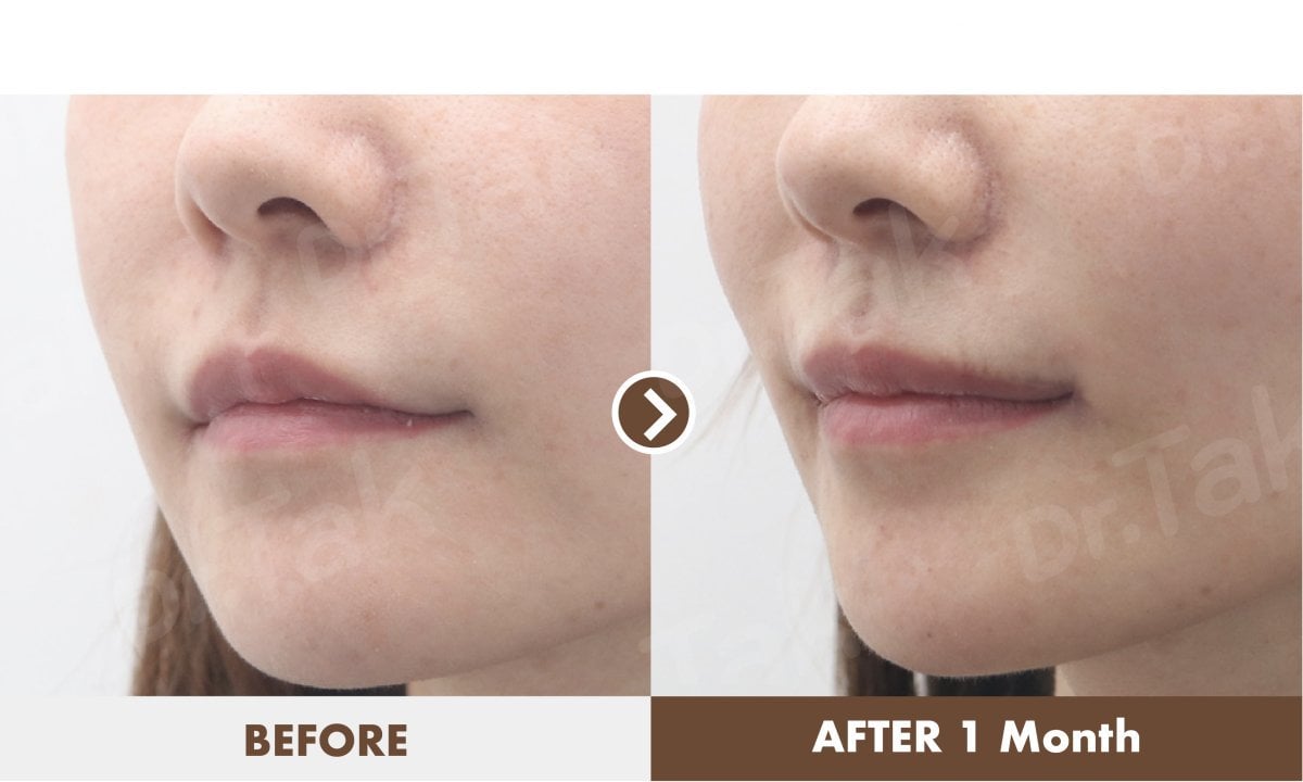Resultados antes y después de lip lift en Dr. Tak Plastic Surgery, mejora del contorno labial