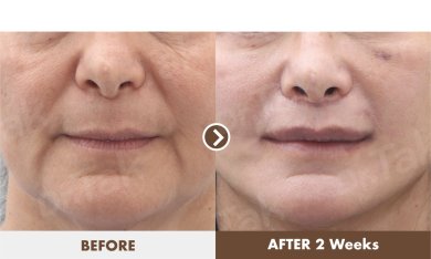 before-after photo lip-lift