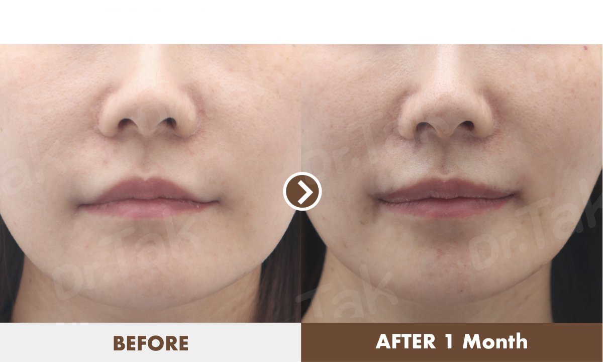 نتيجة رفع الشفاه قبل وبعد شهر في Dr. Tak Plastic Surgery، تحسين شكل الشفاه