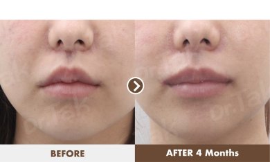 before-after photo lip-lift