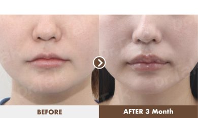 before-after photo lip-lift