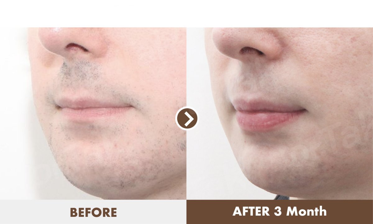 نتائج رفع الشفاه قبل وبعد في Dr. Tak Plastic Surgery – تحسين شكل الشفاه خلال 3 أشهر