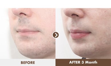 before-after photo lip-lift