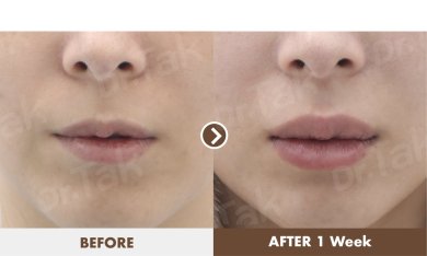 before-after photo lip-lift