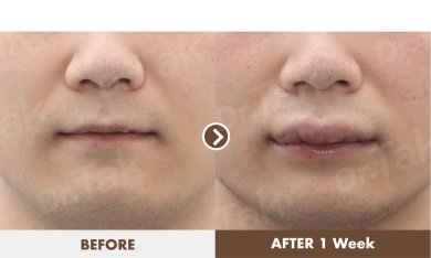 before-after photo lip-lift