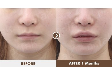 before-after photo lip-lift