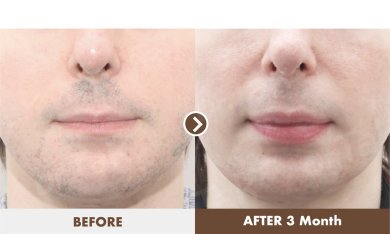 before-after photo lip-lift