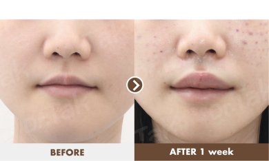 before-after photo lip-lift