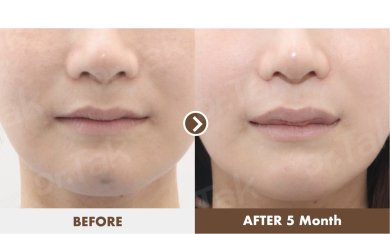 before-after photo lip-lift