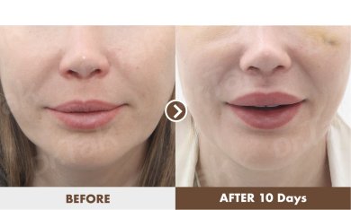 before-after photo lip-lift