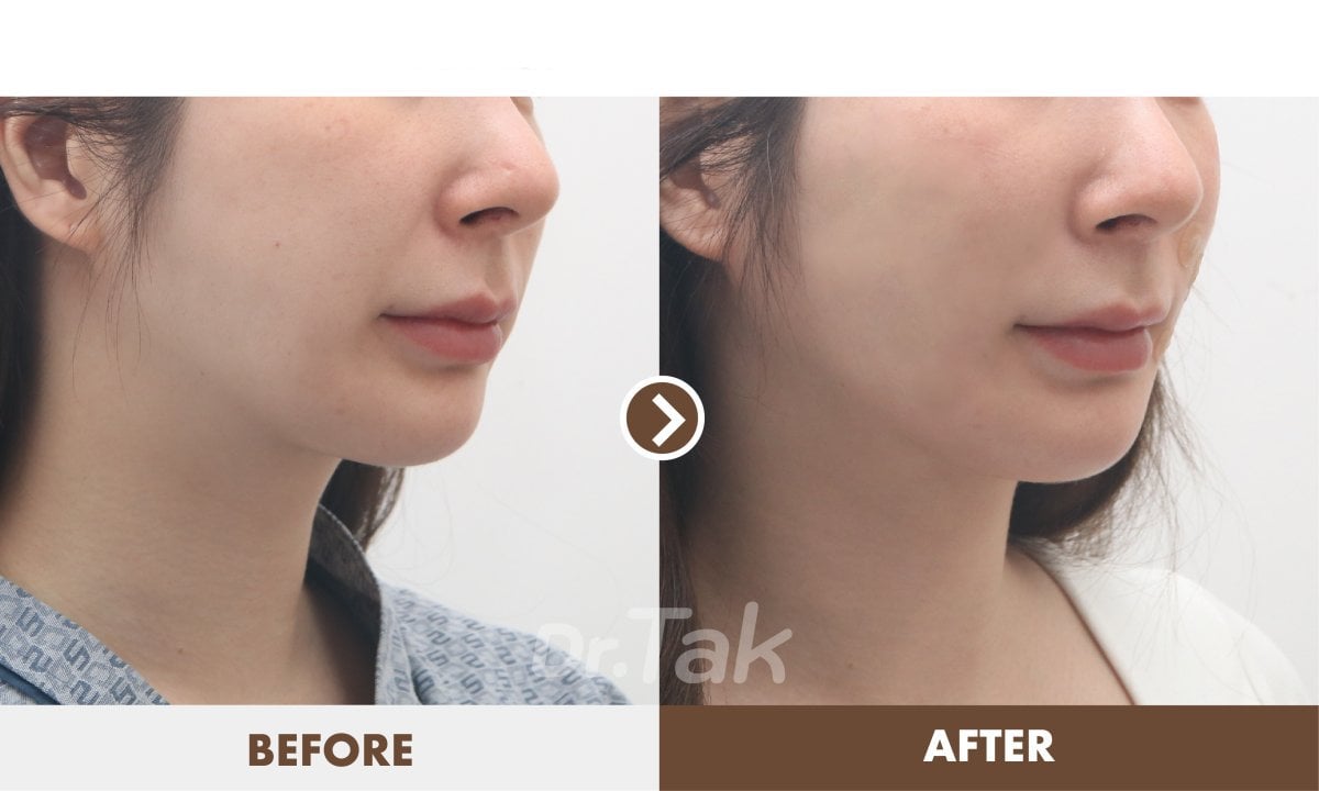 Resultados de lifting facial antes y después en Dr. Tak Plastic Surgery – mejora del contorno