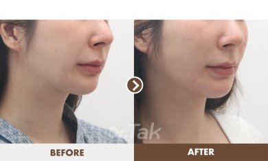 before-after photo tightening-of-facial-skin-facelift