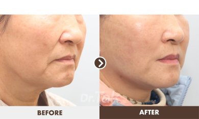 before-after photo tightening-of-facial-skin-facelift