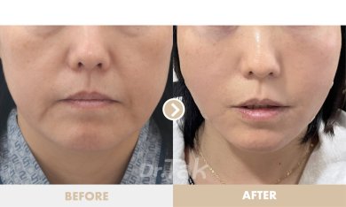 before-after photo tightening-of-facial-skin-facelift