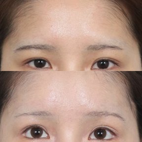before-after photo lifting-lba