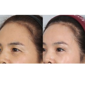before-after photo lifting-lba