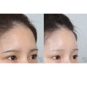 before-after photo lifting-lba