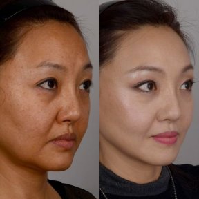before-after photo tightening-of-facial-skin-facelift