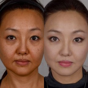 before-after photo tightening-of-facial-skin-facelift