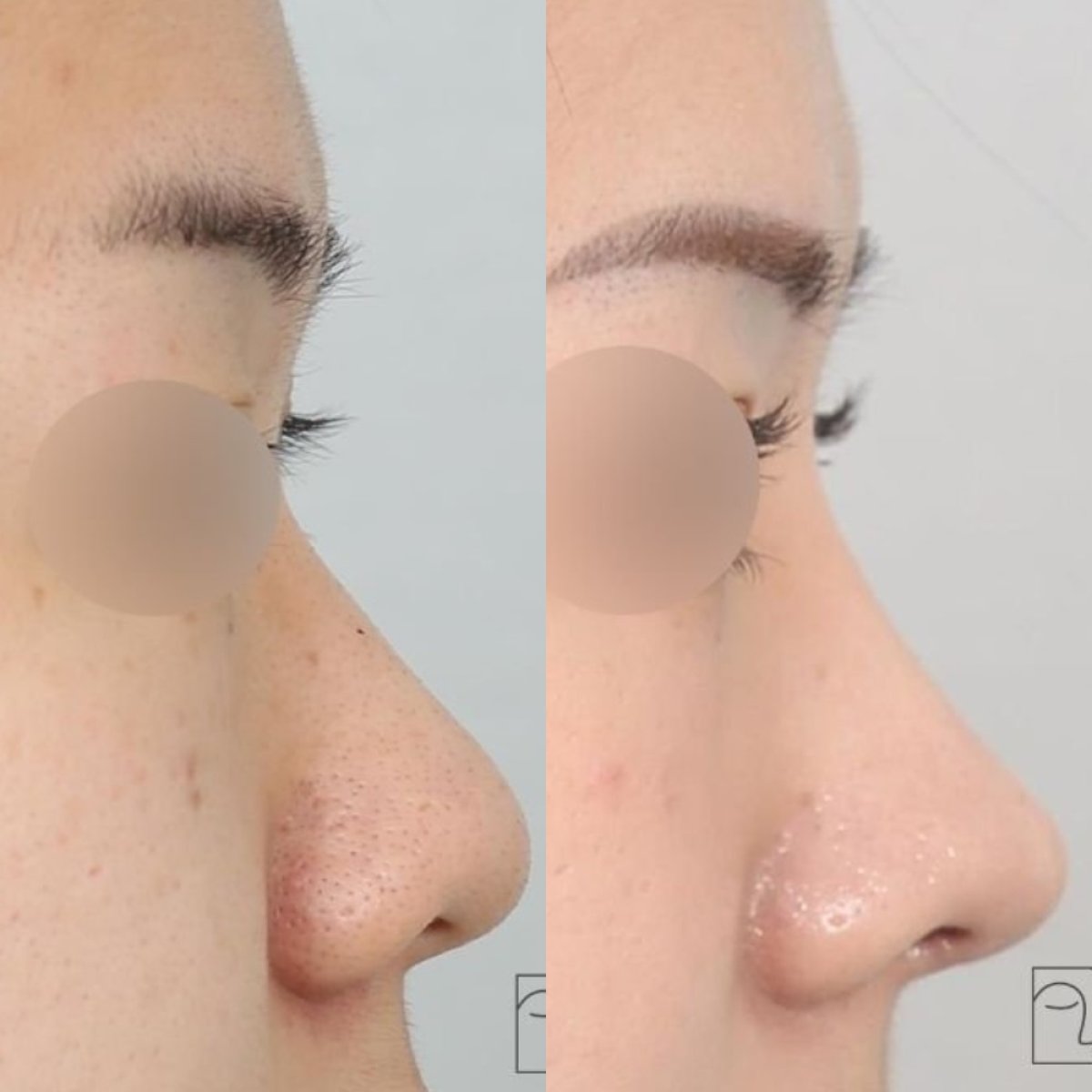 نتائج عملية تجميل الأنف قبل وبعد في عيادة INIQUÉ لجراحة التجميل، إعادة تشكيل الأنف