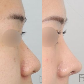 before-after photo rhinoplasty-nose-job