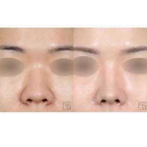 before-after photo rhinoplasty-nose-job