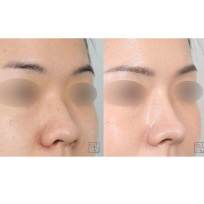 before-after photo rhinoplasty-nose-job