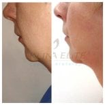 Before and after liposuction results at Klinika Elite Centrum Laseroterapii, chin contouring